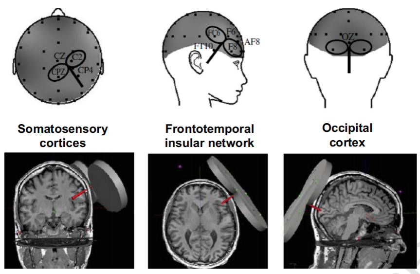 MRI,脑电,TMS MRI,脑电,TMS